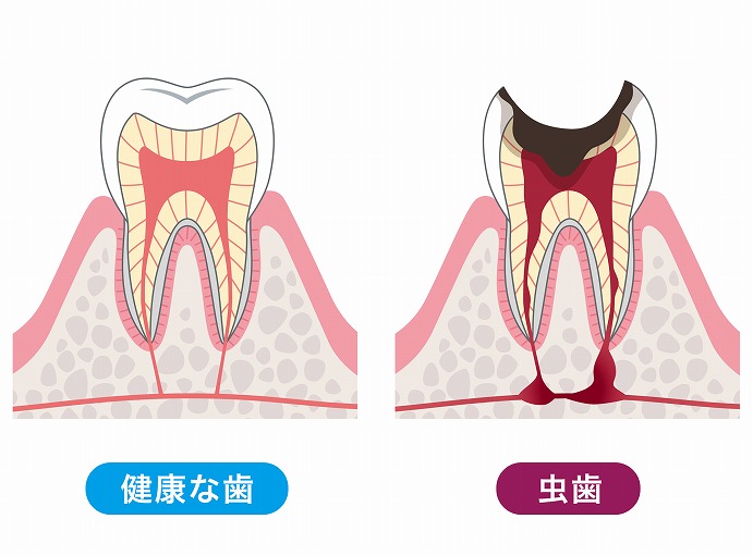 むし歯になる原因