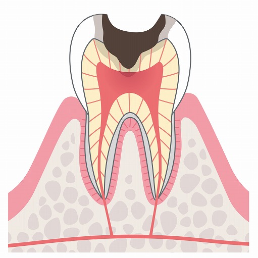 C2：象牙質のむし歯