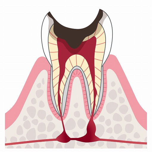 C3：神経（歯髄）のむし歯