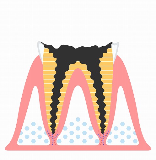 C4：歯質を失ったむし歯