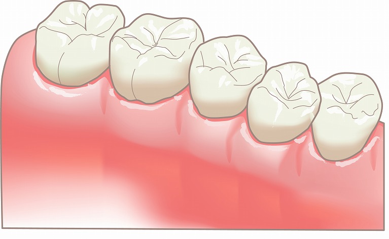 インレー（詰め物）とは？