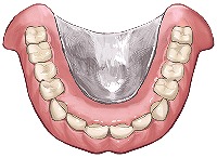 金属床義歯（チタン）