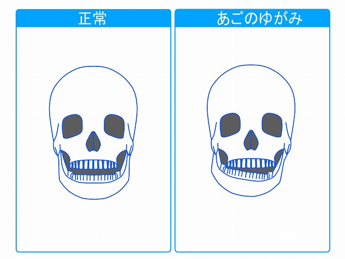 顎関節症について