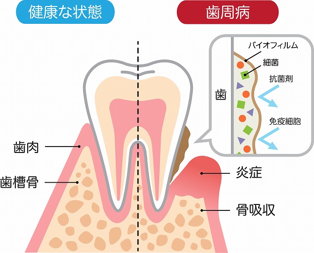 歯周病とは