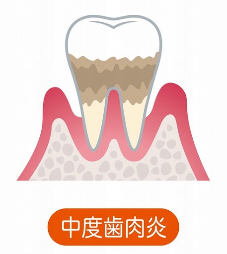 中度の歯周病