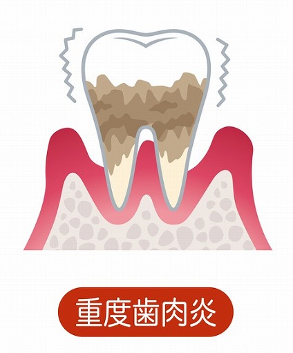 重度の歯周病