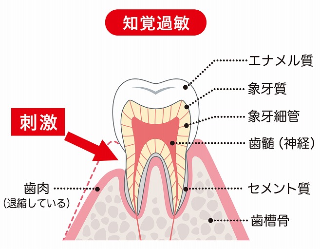 知覚過敏について